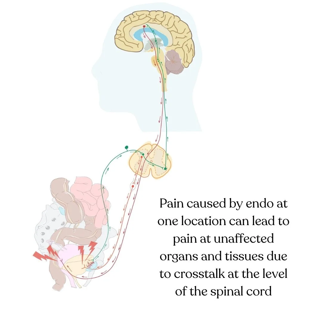 endometriosis pain pelvic floor physical therapy