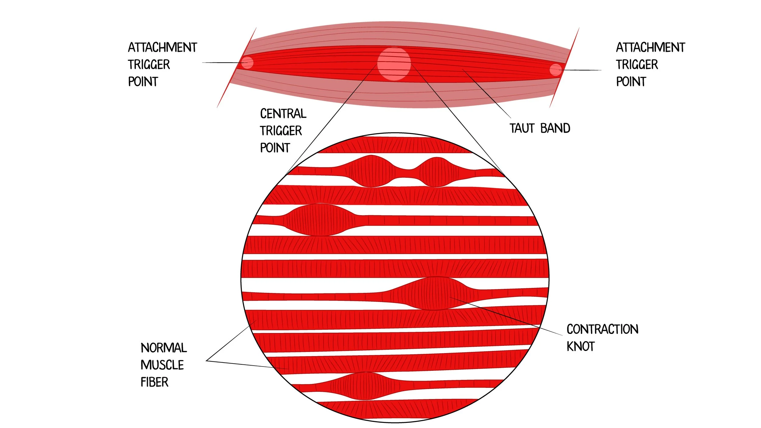 What does dry needling do