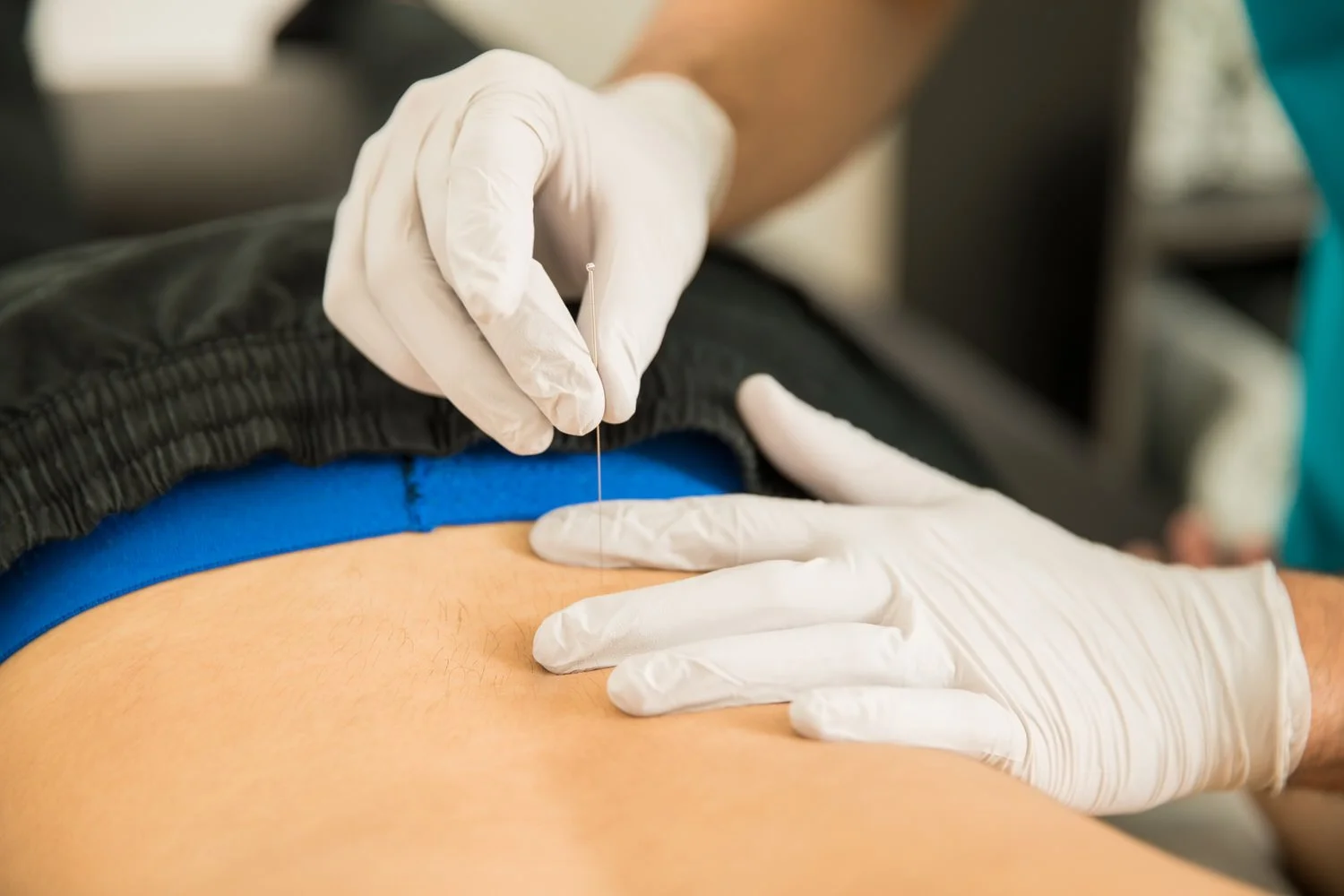 Dry needling for low back and hip pain