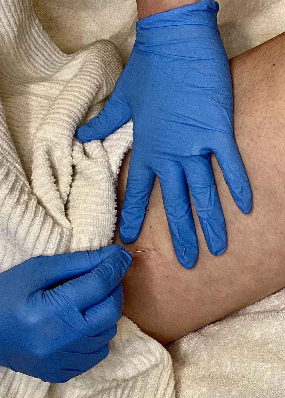 How dry needling is used in physical therapy