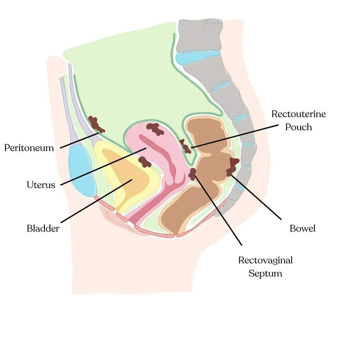endometriosis lesions pelvic pain physical therapy