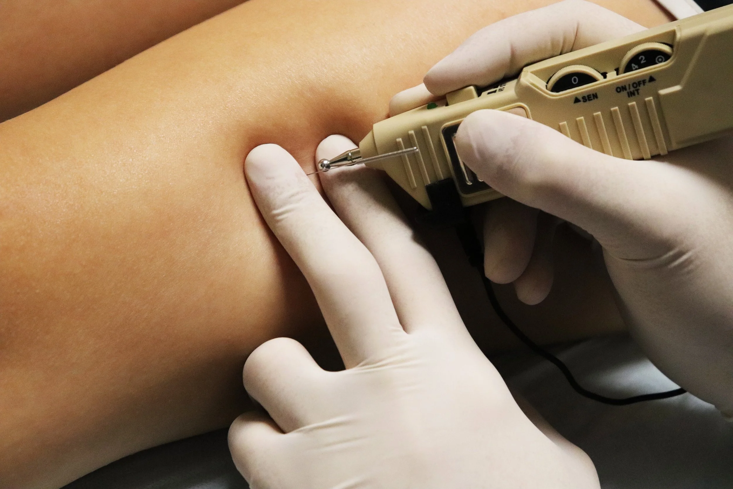 Multi-channel e-stim with dry needling