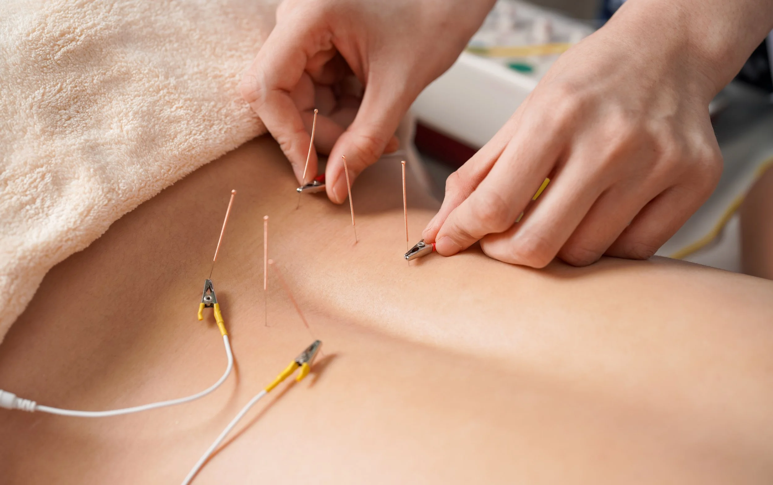 Dry needling with e-stim